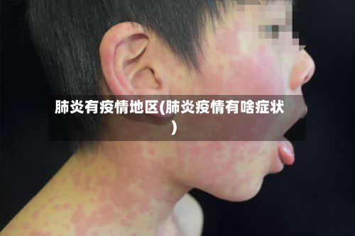 肺炎有疫情地区(肺炎疫情有啥症状)